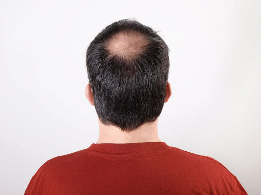 Hair Thinning, Diet and Lifestyle Advice