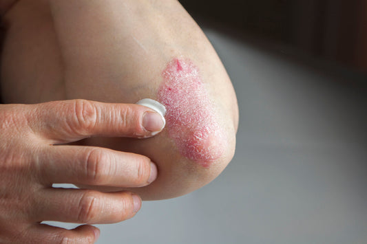 Skin Condition Series, Psoriasis