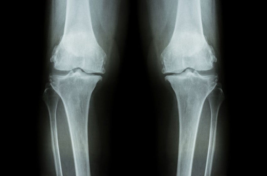 Osteoarthritis, How does it differ from other joint problems?