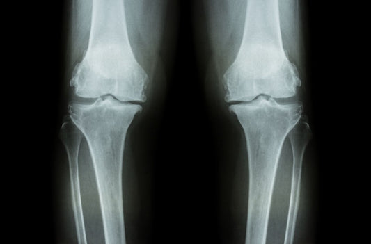 Osteoarthritis, How does it differ from other joint problems?