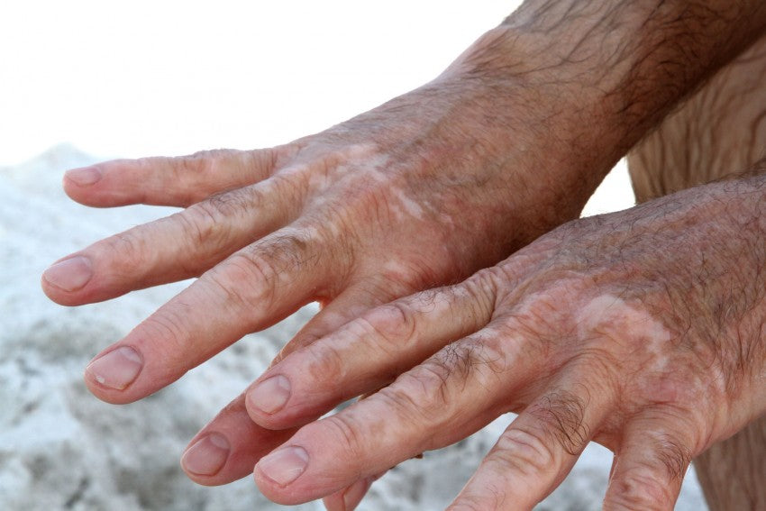 Vitiligo,  What is it, and How is it Treated?